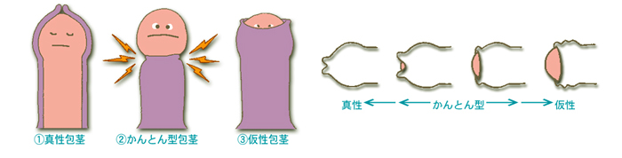 新宿形成外科の包茎手術